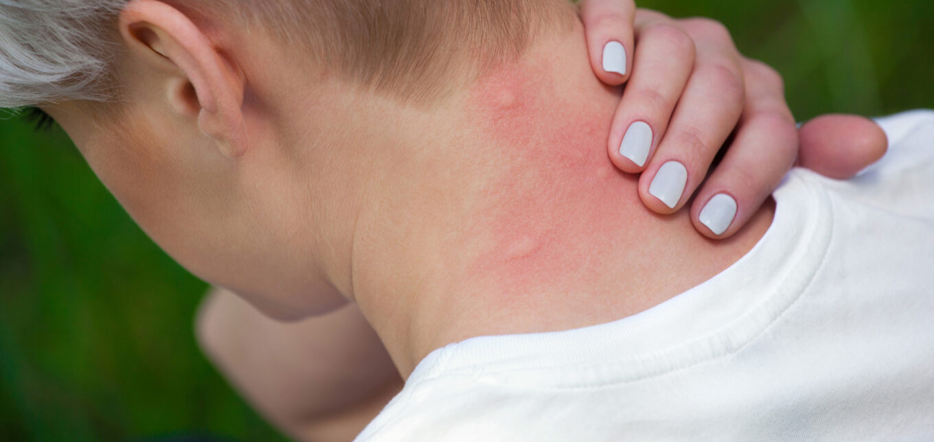 Chiggers Rash Spreading